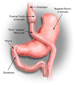 Roux-en-Y Stomach Bypass